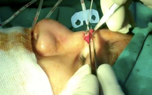 Sau 2 năm thiếu nữ nâng mũi, BS kinh ngạc gắp ra cục gạc