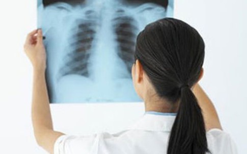 Nghe nước chảy trong phổi, cô gái 22 tuổi phát hiện bị ung thư