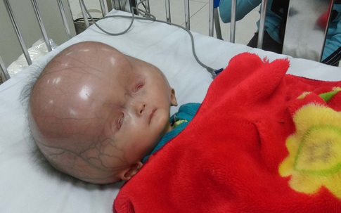 Thông tin mới nhất về bé trai 13 tháng tuổi mắc bệnh có đầu to bất thường