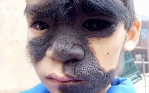 Điều ít biết về bé trai 6 tuổi ở Yên Bái có khuôn mặt dị thường, 2 màu trắng đen rõ rệt