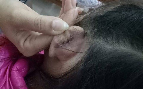 Học sinh lớp 2 bị cô giáo xách đứt tai vì oẳn tù tì trong giờ học