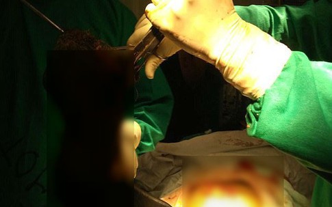 Bác sĩ bàng hoàng phát hiện 1,5kg tóc rối trong bụng của sản phụ mới sinh