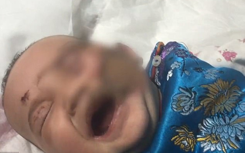 Bé gái 5 tháng tuổi hỏng cả khuôn mặt khi mẹ vắng nhà