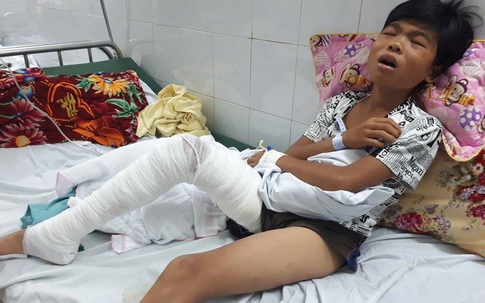 Cậu bé bị hổ tấn công, cào nát chân nằm đau đớn trong viện Bỏng