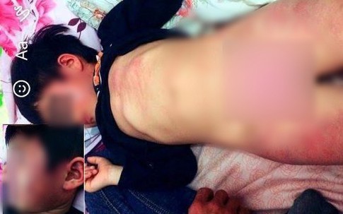 Bắc Giang: Kết luận chính thức vụ bé gái 4 tuổi bị đánh bầm tím tại trường mầm non