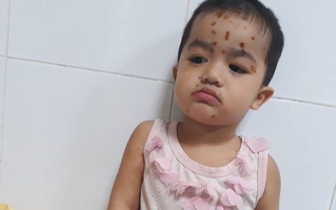 Sức khỏe của bé gái 2 tuổi cùng lúc mắc nhiều bệnh chưa ổn định