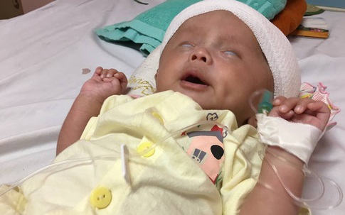Xót xa bé trai mới 1 tháng tuổi đã 3 lần phẫu thuật vì não úng thủy