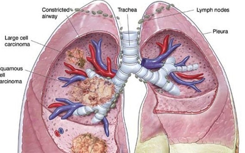 Căn bệnh ung thư ám ảnh, 1 phút có 3 người chết