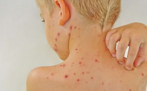 Cẩn trọng với các loại dị ứng trẻ dễ gặp mùa hè