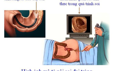 Loại ung thư khiến nhiều người nhầm bệnh... trĩ