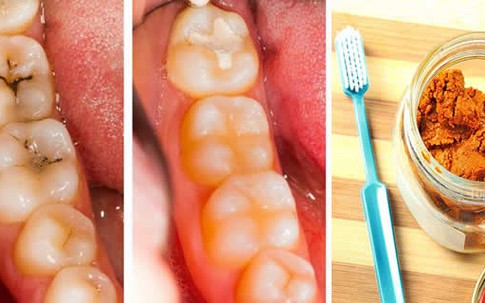 Thấy răng chớm có chấm sâu, đắp liền thứ này vào sẽ khỏi ngay