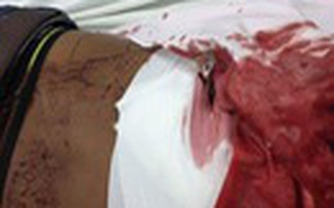 Chở người yêu đi chơi về nam thanh niên bị đâm thủng lưng vì dám "cướp bạn gái" của người khác
