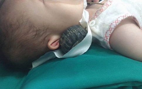 Bé gái 11 tháng tuổi bị đồ chơi đâm xuyên qua má