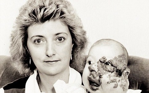 Nhìn cô gái xinh đẹp này ai nghĩ rằng cô từng sở hữu gương mặt biến dạng bị bao người dòm ngó, săm soi