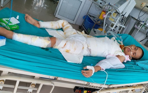 Hơn 20 ngày giành lại sự sống của chàng trai bị cháy ở xưởng bánh kẹo khiến 8 người tử vong