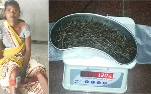 Chụp X-quang, bác sĩ phát hiện nhiều vật lạ trong chân cô gái và không thể tin nổi khi lấy ra