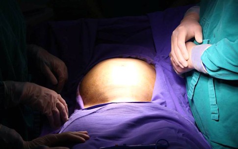 Phát hiện khối u "khủng" gần 7 kg nằm trong ổ bụng bệnh nhân