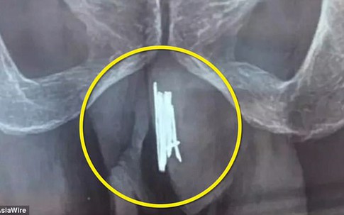 Bác sĩ toát mồ hôi khi mổ gắp 15 cây kim cho quý ông thích 'tự sướng'