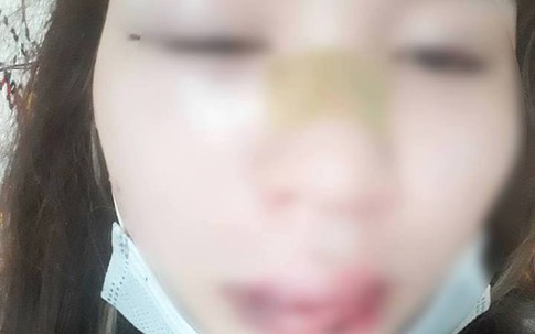 Đồng Nai: Giúp người bị thương, thiếu nữ bị đánh lệch sống mũi