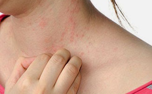 Những bệnh “tác oai, tác quái” vào ngày nắng nóng (1): Mẩn ngứa, mụn nhọt do gan suy giảm chức năng