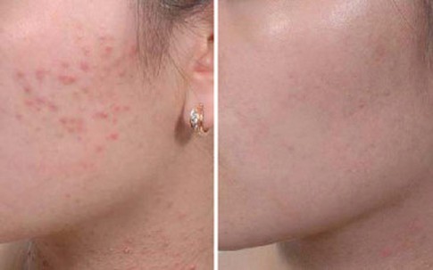 Quy trình chuẩn trị mụn ẩn dưới da tại nhà siêu hiệu quả