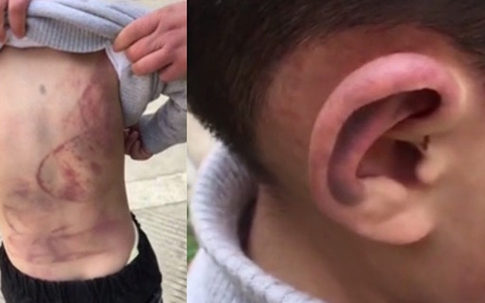 Bị bố đánh dã man, bé trai 6 tuổi không dám về nhà