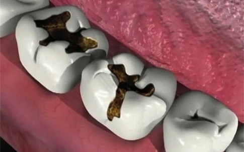 Chỉ vì một cái răng sâu mà tử vong, đừng chủ quan trong điều trị