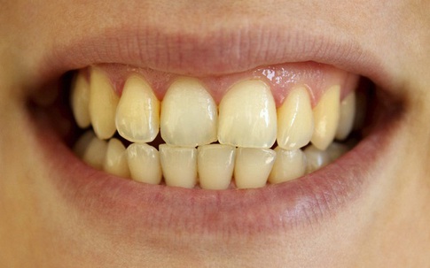 Loạt biến chứng nguy hiểm từ việc lười đánh răng