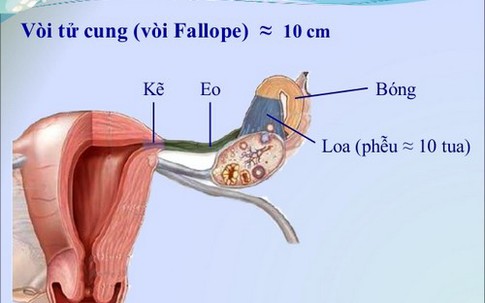 Lần đầu chữa vô sinh do tắc vòi trứng bằng kỹ thuật nong nội soi