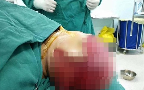 Để tóc xõa trong lúc làm việc, nữ công nhân bị máy sản xuất giật phăng cả mảng da đầu