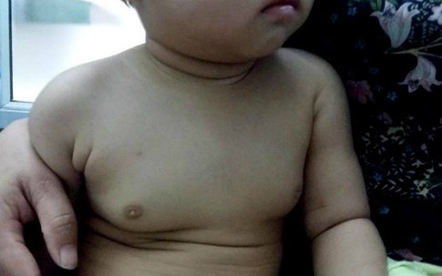 Bé gái 2 tuổi ngực như thiếu nữ 18 do thuốc tránh thai từ mẹ