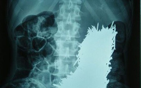 Người đàn ông nuốt hơn 600 chiếc đinh sắt vào bụng