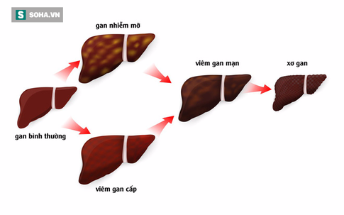 Chuyên gia: Muốn phòng ung thư gan, thay vì "3 sớm" phải tiến hành "6 sớm" mới đủ an toàn
