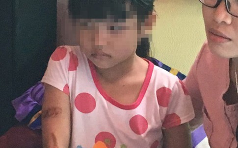 Thông tin mới nhất vụ bé gái 7 tuổi nghi bị cha dí sắt nóng vào mặt