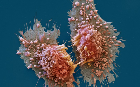 11 loại thực phẩm gây ung thư cao kinh hoàng