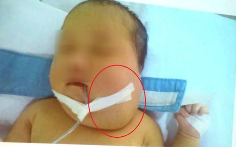 10 giờ phẫu thuật cứu bé sơ sinh mắc căn bệnh đầu tiên ở VN