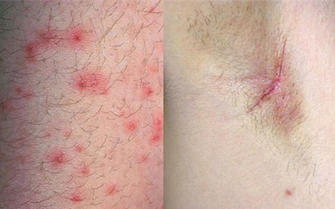 Bạn sẽ bỏ ngay thói quen nhổ lông nách bằng nhíp sau khi đọc bài viết này