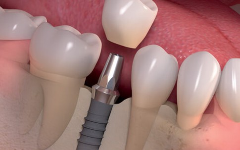 Tiết kiệm thời gian trồng răng Implant với ETK Active