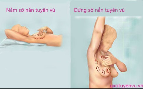 Khi có dấu hiệu sau, 80% là đã mắc ung thư vú