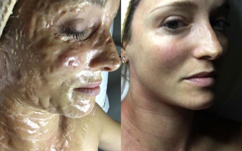 "Mặt nạ da rồng" làm da bạn sần sùi, lồi lõm kỳ dị nhưng gỡ ra thì lại hồng hào, căng bóng