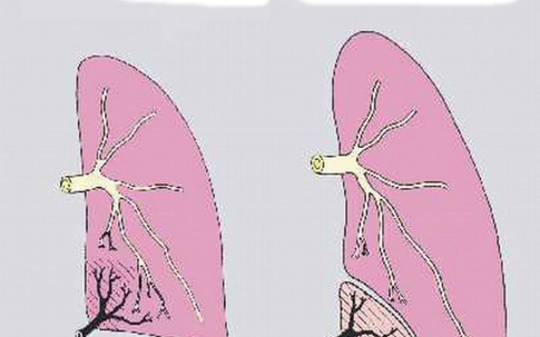 Bé gái có 'phổi biệt trí'