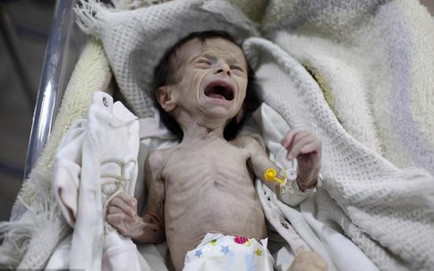 Em bé Syria với thân hình chỉ còn da bọc xương giữa bom đạn chiến tranh khiến cả thế giới xót xa