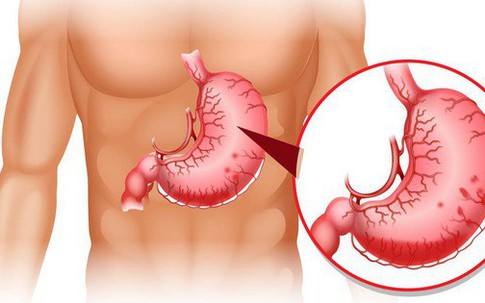 Để không bị bệnh viêm dạ dày tấn công bạn, chỉ cần nhớ công thức 7 "không"