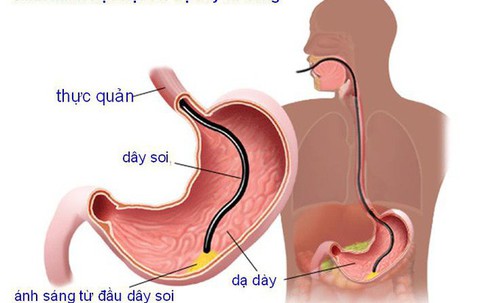 6 nhóm người có nguy cơ cao mắc ung thư dạ dày, đừng để khối u 'làm tổ' rồi mới đi khám