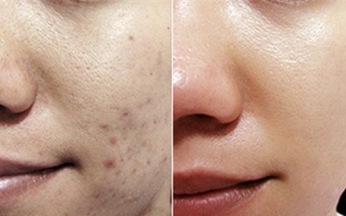 Tẩm bông gòn với nước chanh pha loãng thoa lên da – kết quả khiến bạn muốn làm theo ngay lập tức