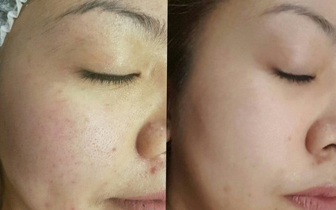 3 xu hướng thẩm mỹ làm đẹp da hot nhất năm 2017