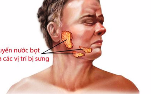 Nhiều người nhầm quai bị với bệnh nguy hiểm