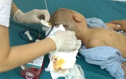 Thái Bình: Bé trai 3 tuổi đi học ở trường mầm non bị tụ máu 1/4 não phải mổ cấp cứu