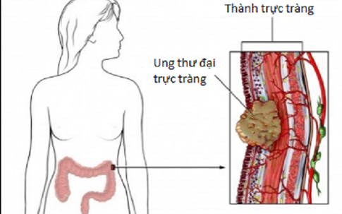 Mắc các dấu hiệu sau, cần đi khám phát hiện ung thư đại trực tràng ngay