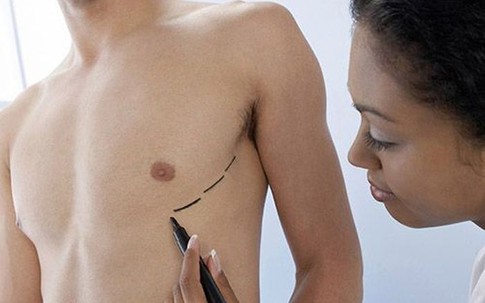 Những dấu hiệu giúp nhận biết ung thư vú ở nam giới